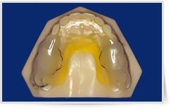 Bite Federici